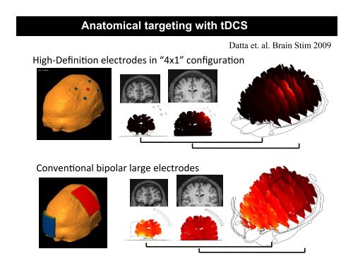 Direct Current Stimulation (HD-tDCS)