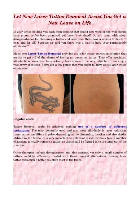 Let New Laser Tattoo Removal Assist You Get a New Lease on Life