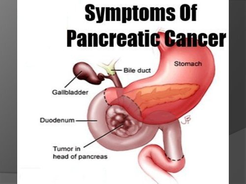 Pancreas Cancer symptoms