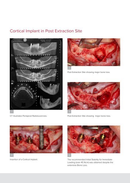 Cortical Implants Brochure - Noris Medcical 