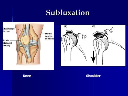 Dislocation/Subluxation Management Or ‘I’m Just Popping Out for a While!’