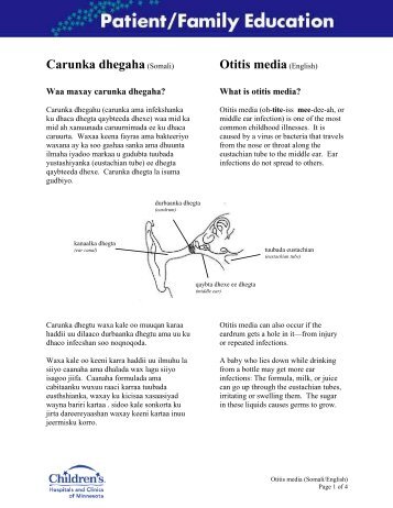 Otitis Media (Somali) - Children's Hospitals and Clinics of Minnesota