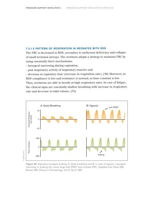 Pressure Support Ventilation - A New Triggered Venilation Mode for Neonates