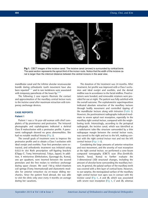 Approximation and contact of the maxillary central incisor roots with the incisive canal after maximum retraction with temporary anchorage devices_ Report of 2 patients