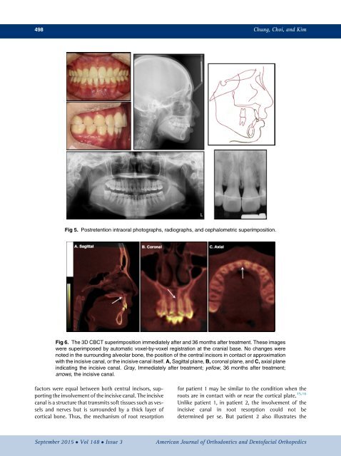 Approximation and contact of the maxillary central incisor roots with the incisive canal after maximum retraction with temporary anchorage devices_ Report of 2 patients