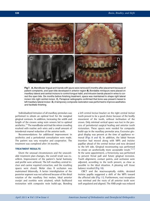 Moving an incisor across the midline_ A treatment alternative in an adolescent patient