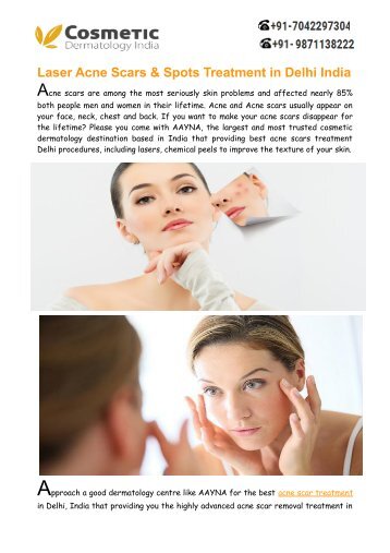 Best Acne Scars Treatment Delhi India – Aayna Clinic