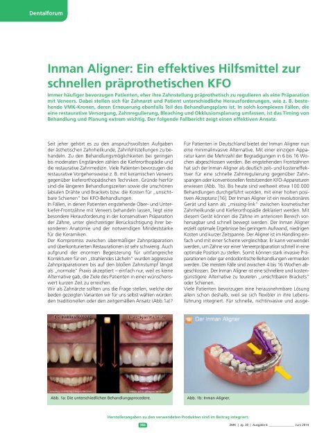 Dr. Nolte -Dentalforum 08-2014-IA Ein effektives Hilfsmittel zu schnellen präprothetischen KFO