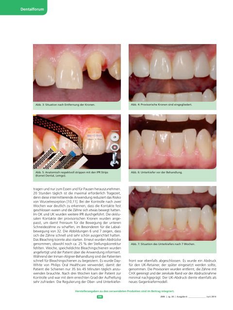Dr. Nolte -Dentalforum 08-2014-IA Ein effektives Hilfsmittel zu schnellen präprothetischen KFO