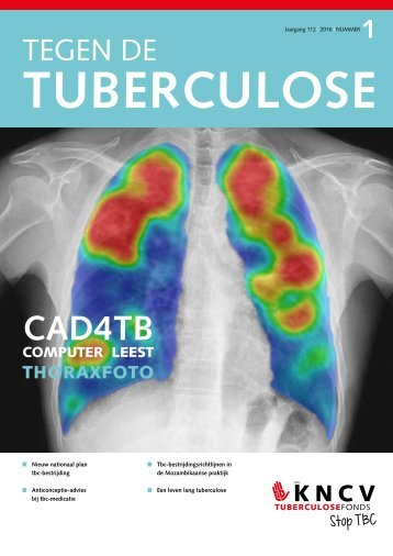 Tuberculose