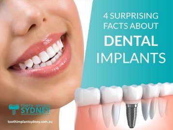 Surprising Facts on Dental Implants!