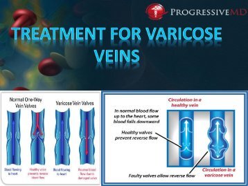 Treatment for Varicose Veins In Los Angeles CA