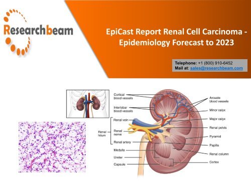 EpiCast Report Renal Cell Carcinoma Epidemiology Forecast to 2023