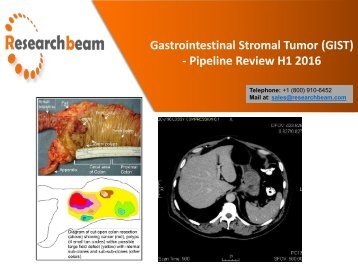 Gastrointestinal Stromal Tumor GIST - Pipeline Review H1 2016