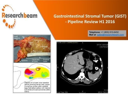 Gastrointestinal Stromal Tumor GIST - Pipeline Review H1 2016