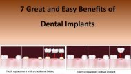 7 Great And Easy Benefits of Dental Implants