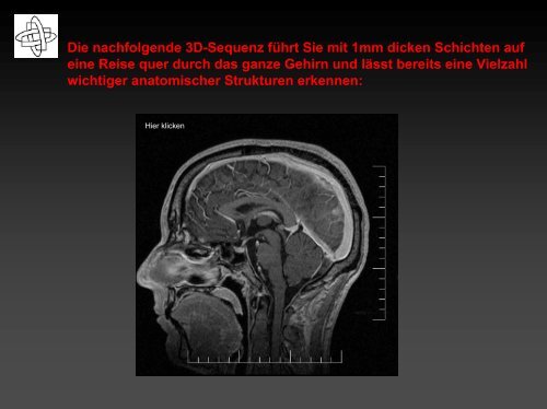 Neuroradiologie – Einblicke Ins Gehirn - Ulmmed