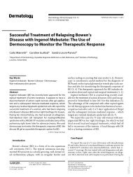 Successful Treatment of Relapsing Bowen’s
Disease with Ingenol Mebutate: The Use of
Dermoscopy to Monitor the Therapeutic Response