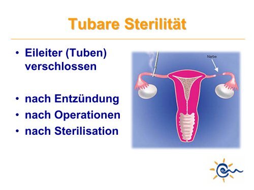 Was ist IVF - Kinderwunsch Praxis Tübingen