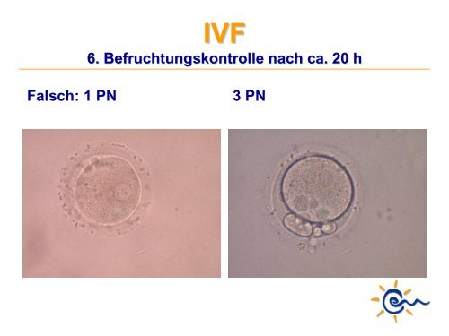 Was ist IVF - Kinderwunsch Praxis Tübingen