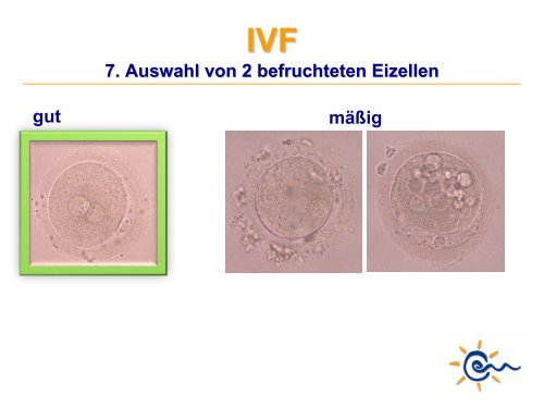 Was ist IVF - Kinderwunsch Praxis Tübingen