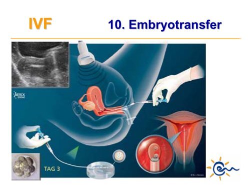 Was ist IVF - Kinderwunsch Praxis Tübingen