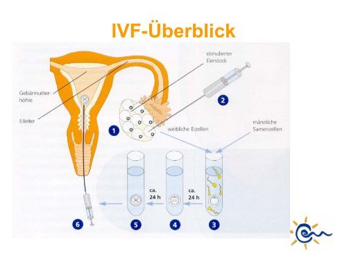 Was ist IVF - Kinderwunsch Praxis Tübingen