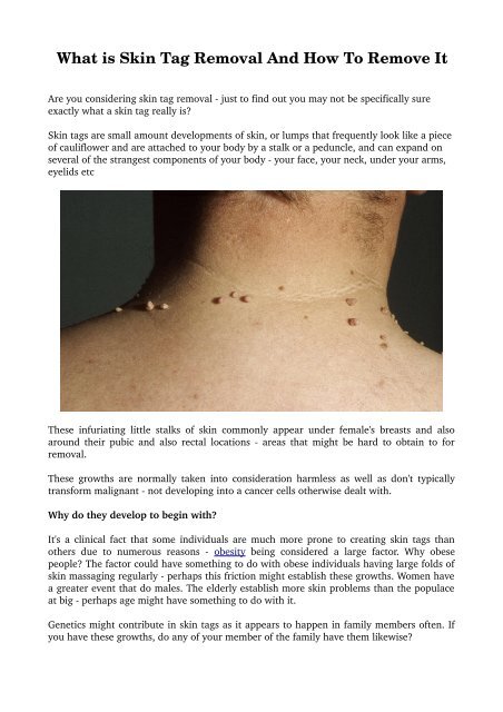 What is Skin Tag Removal And How To Remove It