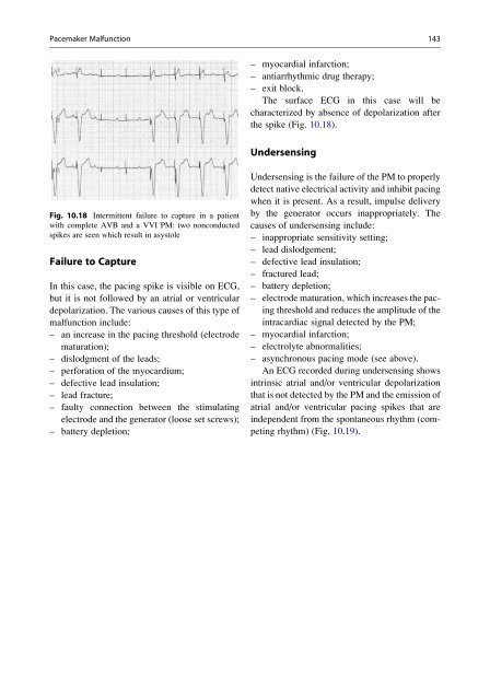 Pacemaker Malfunction 143 pacemaker-malfunction-143
