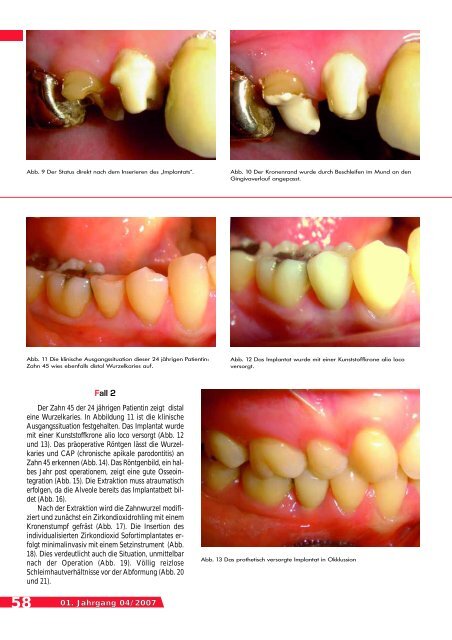 ANALOG ZUR ALVEOLE - BioImplant