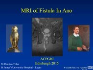 MRI of Fistula In Ano