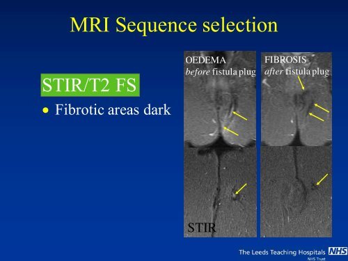 MRI of Fistula In Ano