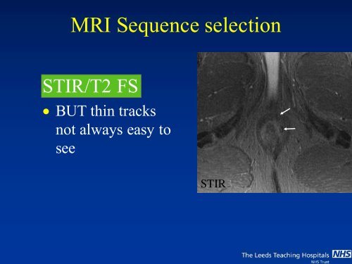 MRI of Fistula In Ano