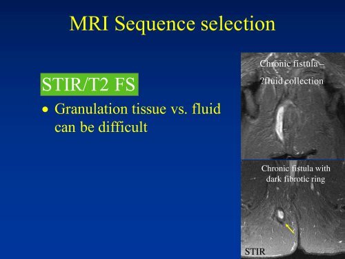 MRI of Fistula In Ano