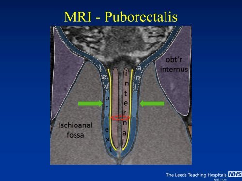 MRI of Fistula In Ano