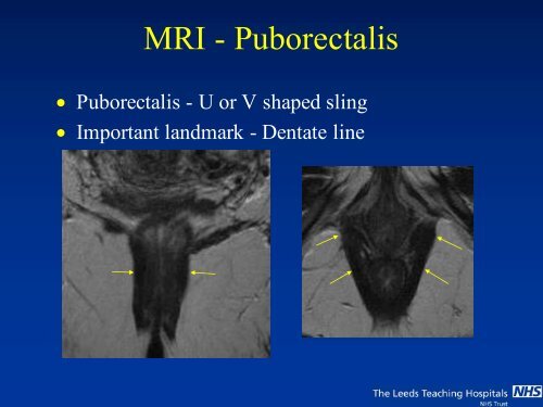 MRI of Fistula In Ano