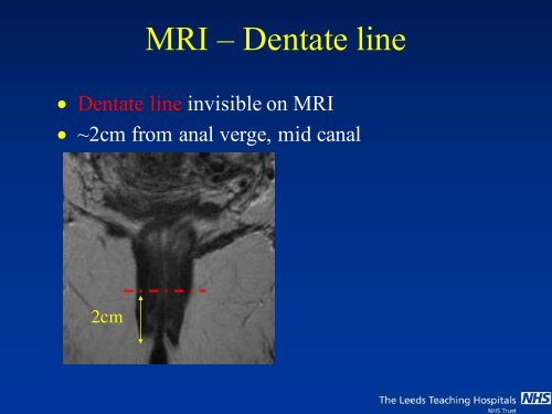 MRI of Fistula In Ano