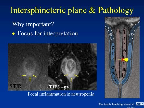 MRI of Fistula In Ano