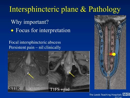 MRI of Fistula In Ano