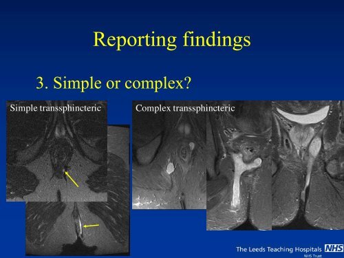 MRI of Fistula In Ano