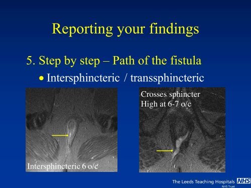 MRI of Fistula In Ano