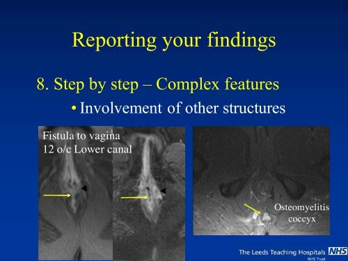 MRI of Fistula In Ano