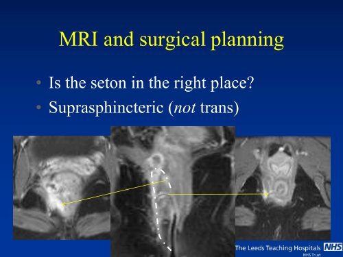 MRI of Fistula In Ano