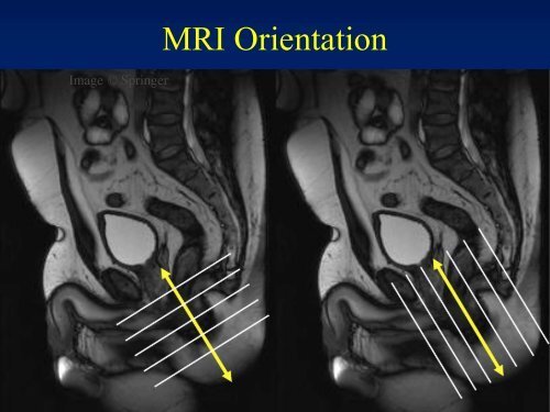 MRI of Fistula In Ano