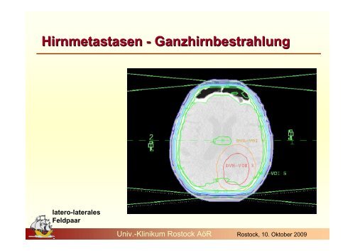 palliative Therapie - Strahlentherapie