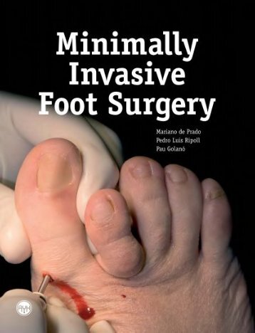 Minimally Invasive Foot Surgery