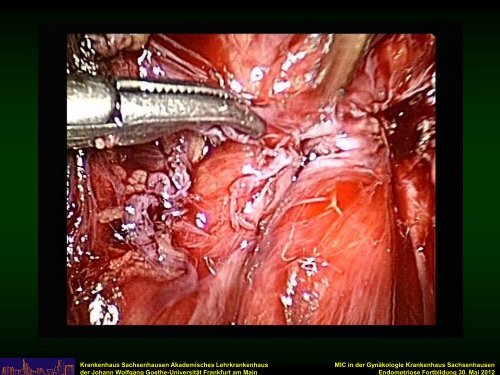 Die operative Therapie der tief infiltrierenden Endometriose