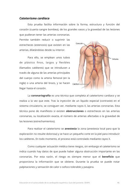 Que es un cateterismo de corazon riesgos