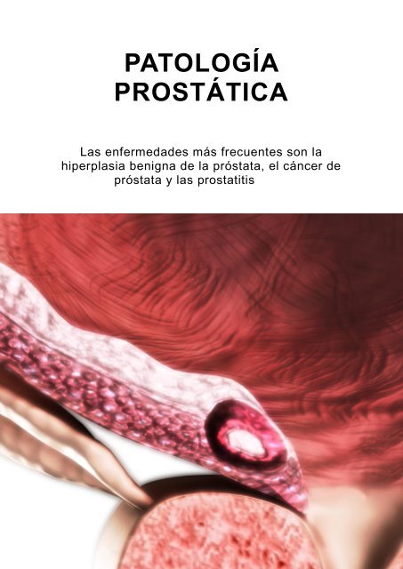 índice de próstata del área hipoecoica