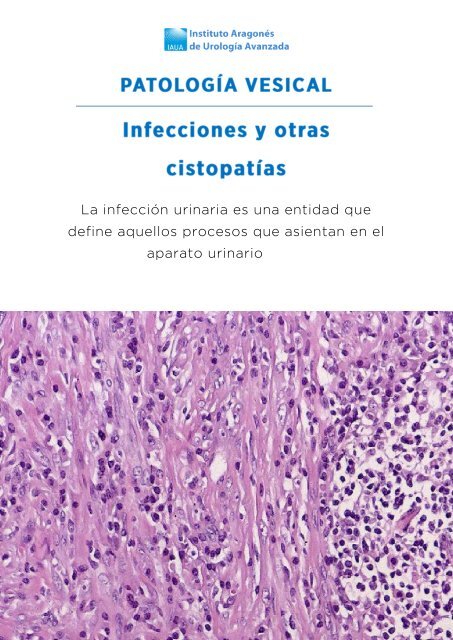 infecciones de prostatitis conducen a infertilidad